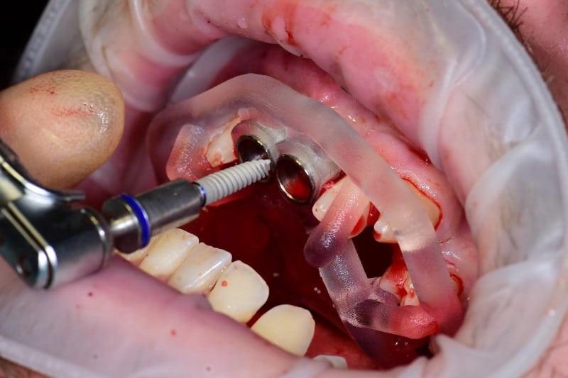 Guided Implant Case - Image 4